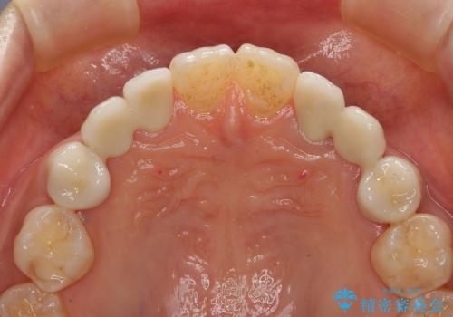 [歯周外科] 歯ぐきの状態を改善した審美ブリッジ治療の治療後