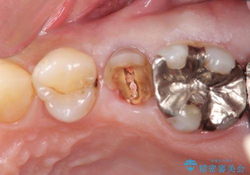 [歯牙挺出] 深い虫歯の歯を抜かずに残す治療　の治療前