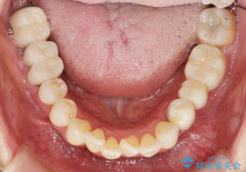 [歯周病治療] インプラントを用いない重度歯周病治療の治療中