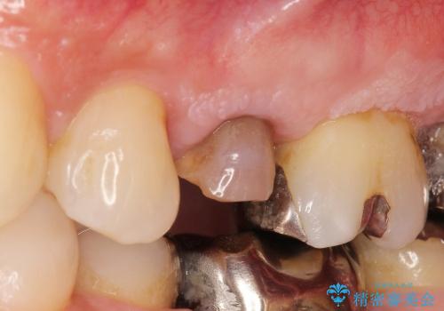 [歯牙挺出] 深い虫歯の歯を抜かずに残す治療　の治療前