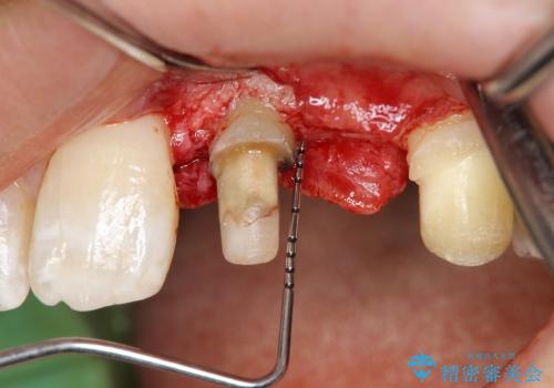 [歯周外科] 歯ぐきの状態を改善した審美ブリッジ治療の治療中