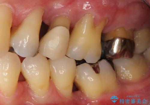 [歯周病治療] インプラントを用いない重度歯周病治療の治療前