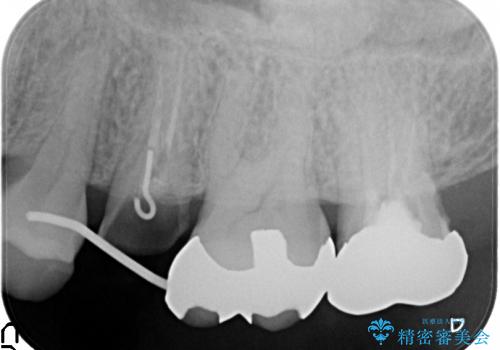 [歯牙挺出] 深い虫歯の歯を抜かずに残す治療　の治療中