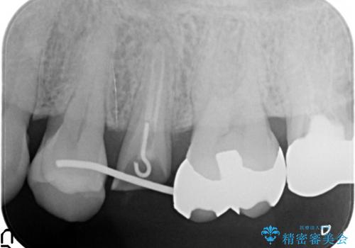 [歯牙挺出] 深い虫歯の歯を抜かずに残す治療　の治療中