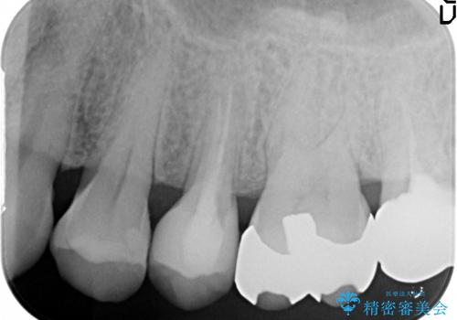 [歯牙挺出] 深い虫歯の歯を抜かずに残す治療　の治療後