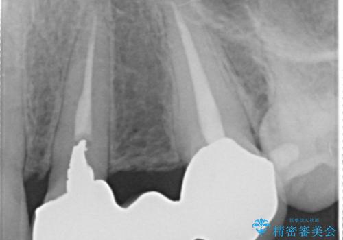 [歯周外科] 歯ぐきの状態を改善した審美ブリッジ治療の治療前