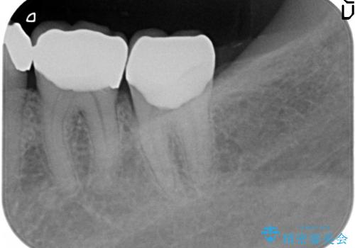 前歯のセラミックのやりかえと虫歯の歯のセラミック治療の治療後