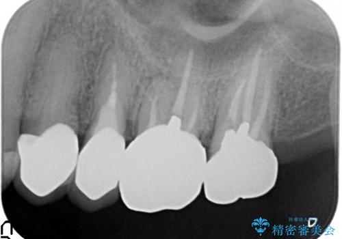 前歯のセラミックのやりかえと虫歯の歯のセラミック治療の治療後