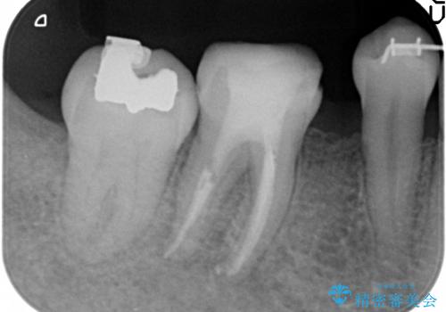 30代女性　矯正中の歯ぐきの腫れの治療後