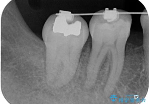 30代女性　矯正中の歯ぐきの腫れの治療前