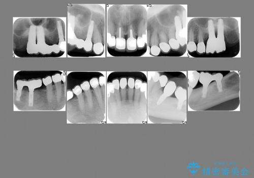 セラミックできれいな歯に　セラミックのやり変えの治療後