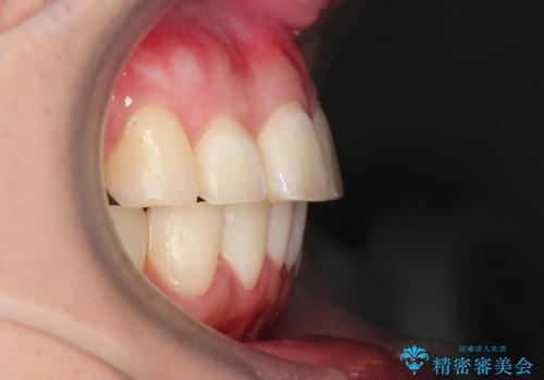 30代男性　出っ歯のワイヤー矯正の治療後