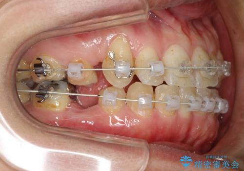 前歯のガタガタ / 歯の真ん中を揃えるの治療中