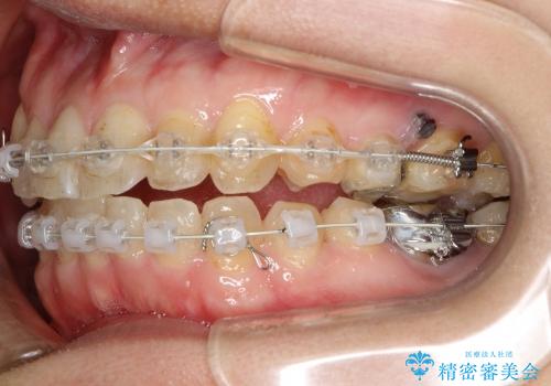 前歯のガタガタ / 歯の真ん中を揃えるの治療中