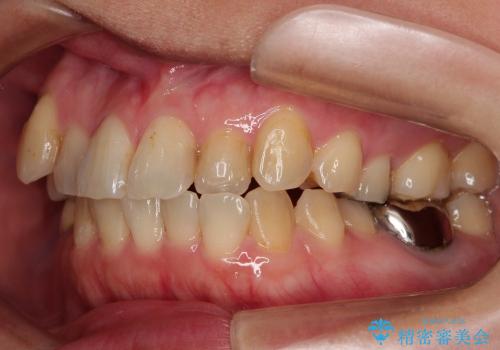 前歯のガタガタ / 歯の真ん中を揃えるの治療前