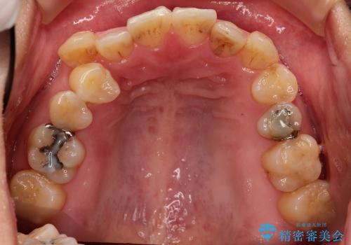 前歯のガタガタ / 歯の真ん中を揃えるの治療前
