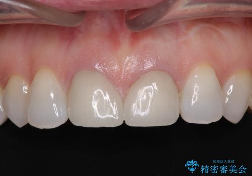 スキッ歯の前歯　部分矯正とオールセラミックの治療後