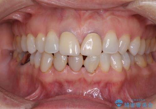 スキッ歯の前歯　部分矯正とオールセラミックの治療前