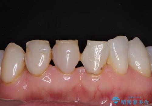 スキッ歯の前歯　部分矯正とオールセラミック