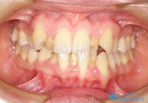 八重歯・クロスバイトの矯正治療　クリアブラケット　1年半の治療前