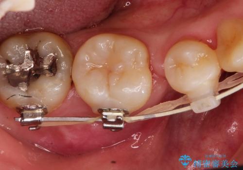 30代女性　矯正中の歯ぐきの腫れの治療前