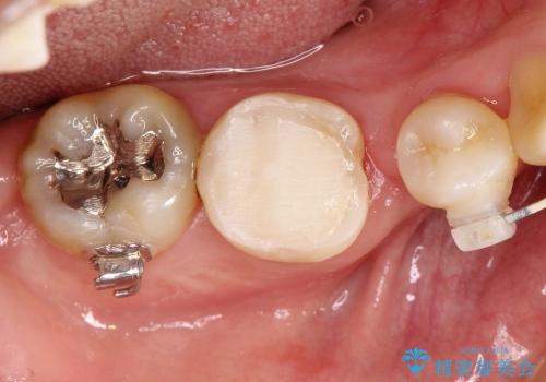 30代女性　矯正中の歯ぐきの腫れの治療後