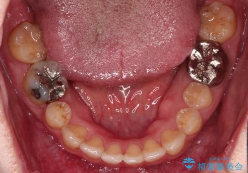 前歯のガタガタ / 歯の真ん中を揃えるの治療後