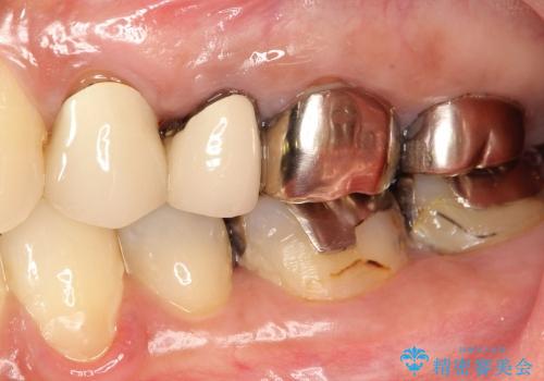 前歯のセラミックのやりかえと虫歯の歯のセラミック治療の治療前
