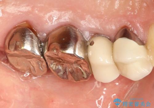 前歯のセラミックのやりかえと虫歯の歯のセラミック治療の治療前
