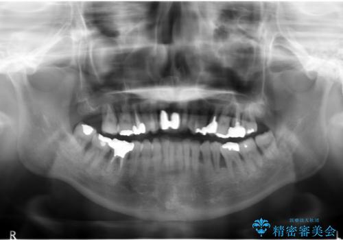[歯周病治療] インプラントを用いない重度歯周病治療の治療前