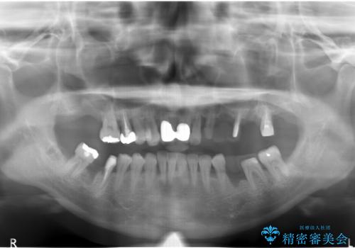 [歯周病治療] インプラントを用いない重度歯周病治療の治療中