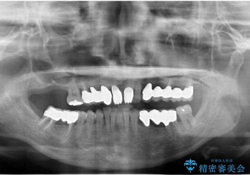 [歯周病治療] インプラントを用いない重度歯周病治療の治療後