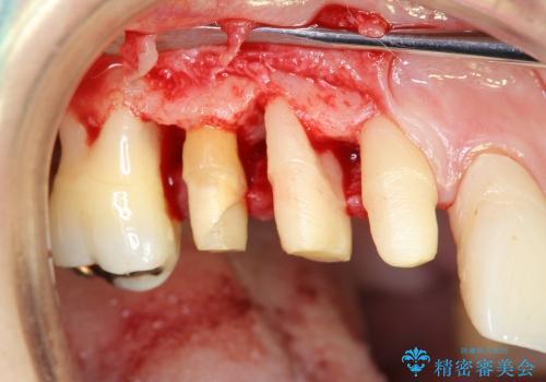 [歯周病治療] インプラントを用いない重度歯周病治療