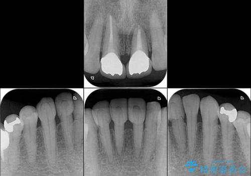 スキッ歯の前歯　部分矯正とオールセラミックの治療後