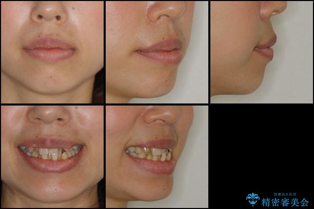 八重歯・クロスバイトの矯正治療　クリアブラケット　1年半の治療前（顔貌）