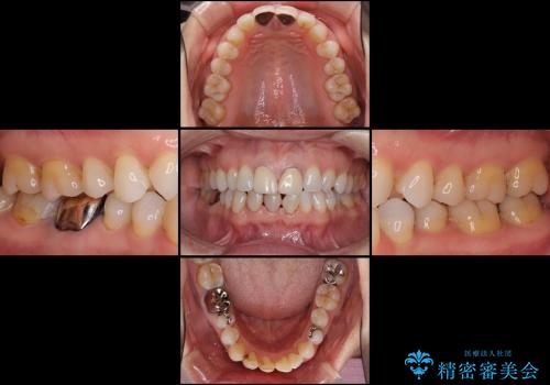 スキッ歯の前歯　部分矯正とオールセラミックの治療前