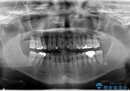 前歯のガタガタ / 歯の真ん中を揃えるの治療後