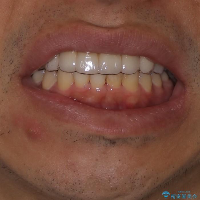 30代男性　全顎矯正+セラミックブリッジ①の治療後（顔貌）