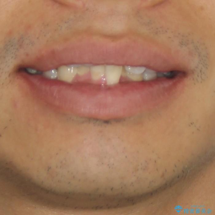 30代男性　全顎矯正+セラミックブリッジ①の治療前（顔貌）