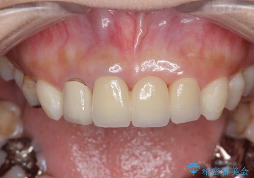 [前歯の審美回復] 前歯の入れ歯をオールセラミックブリッジへの治療後