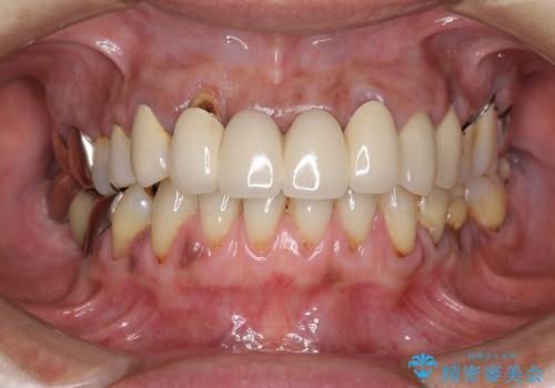 [歯周ポケット除去]  歯周病を改善してからの前歯部ブリッジの治療前