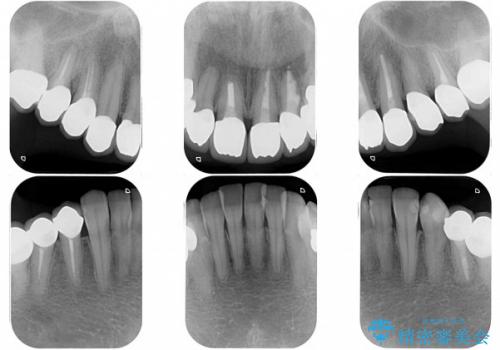 虫歯がたくさん　歯肉深くにまで及んだ虫歯の治療の治療後
