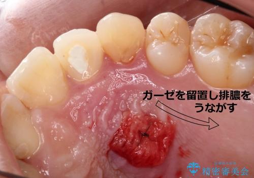 20代女性　前歯の不良な詰め物から大きな病気へ→根本から治療の治療中
