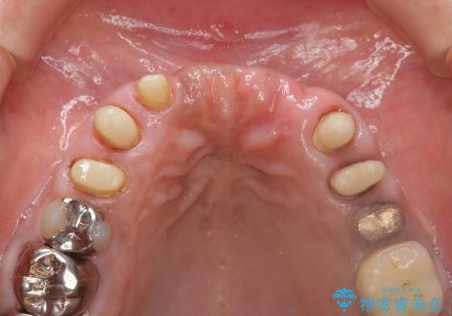 [歯周ポケット除去]  歯周病を改善してからの前歯部ブリッジの治療中