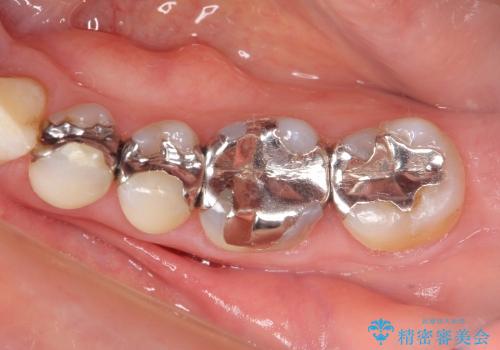 [セラミックインレー] 銀歯を白くする虫歯治療の症例 治療前