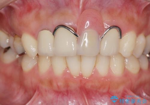 [前歯の審美回復] 前歯の入れ歯をオールセラミックブリッジへの治療前