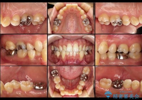 深い虫歯と銀歯をきれいなセラミックにの症例 治療前