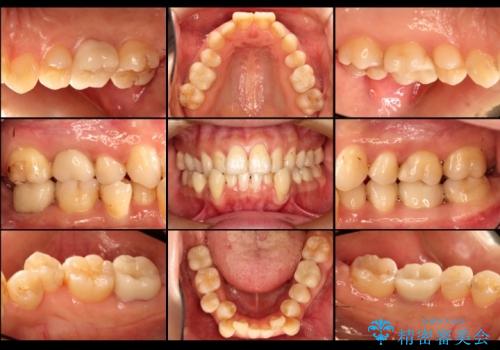 深い虫歯と銀歯をきれいなセラミックにの治療後