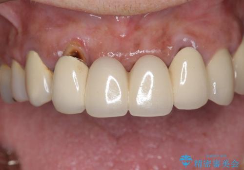 [歯周ポケット除去]  歯周病を改善してからの前歯部ブリッジの症例 治療前
