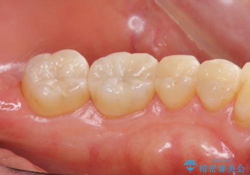 [セラミックインレー] 銀歯を白くする虫歯治療の治療後